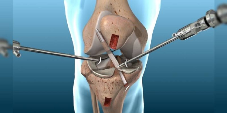 Knee Arthroscopy For Knee Injuries